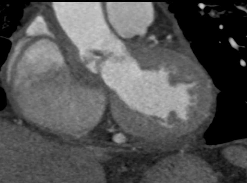 Thrombus on the Aortic Valve Leaflets - CTisus CT Scan