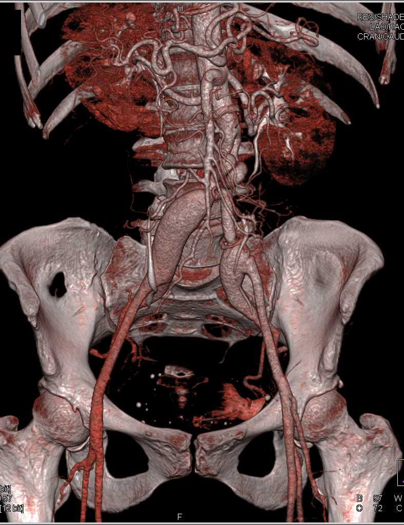Iliac Artery Aneurysms - CTisus CT Scan