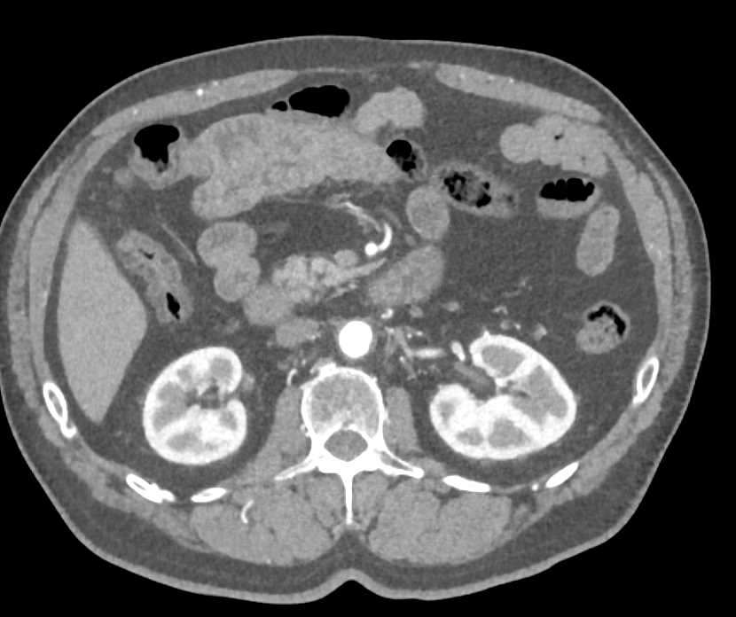 Below Knee Amputation (BKA) with Occlude Flow to the Right - CTisus CT Scan