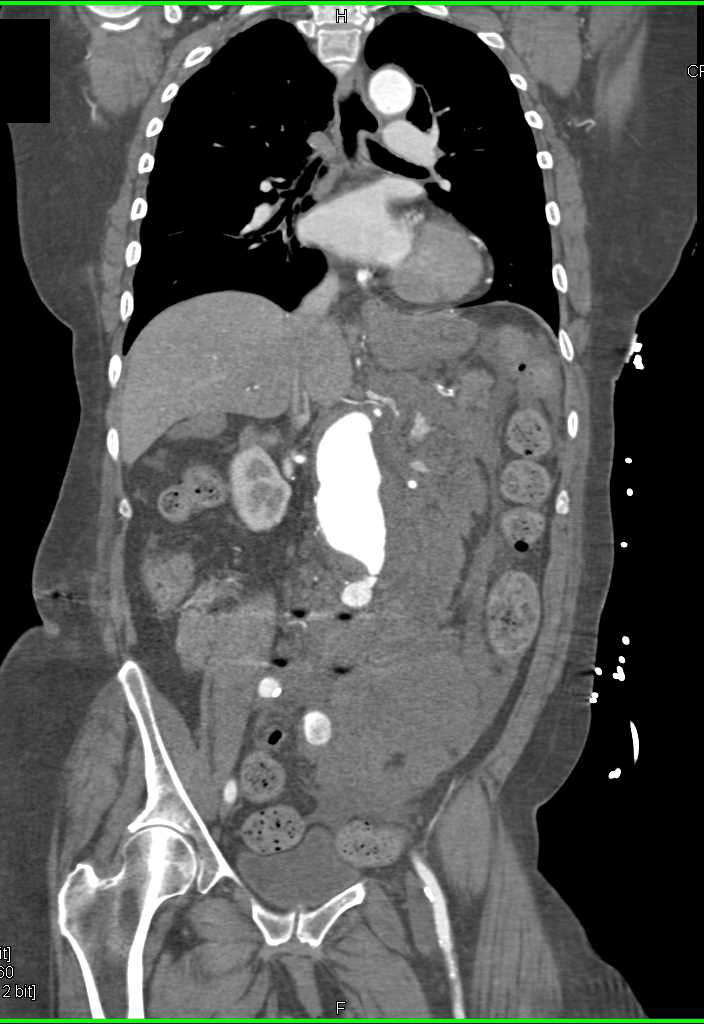 Active Bleeding Abdominal Aortic Aneurysm - CTisus CT Scan