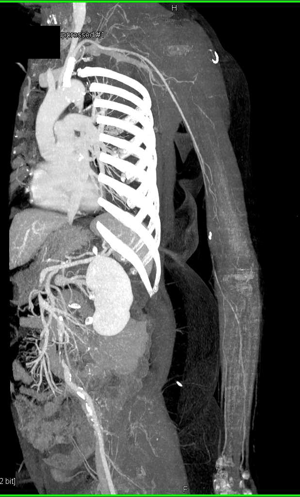 Occluded Left Brachial Artery - CTisus CT Scan
