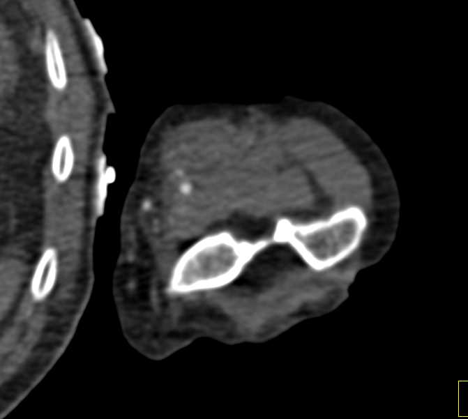 Brachial Artery Aneurysm in Intravenous Drug Abuse (IVDA) Patient - CTisus CT Scan