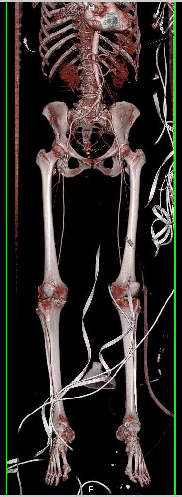 Peripheral Vascular Disease (PVD) on Runoff Study - CTisus CT Scan