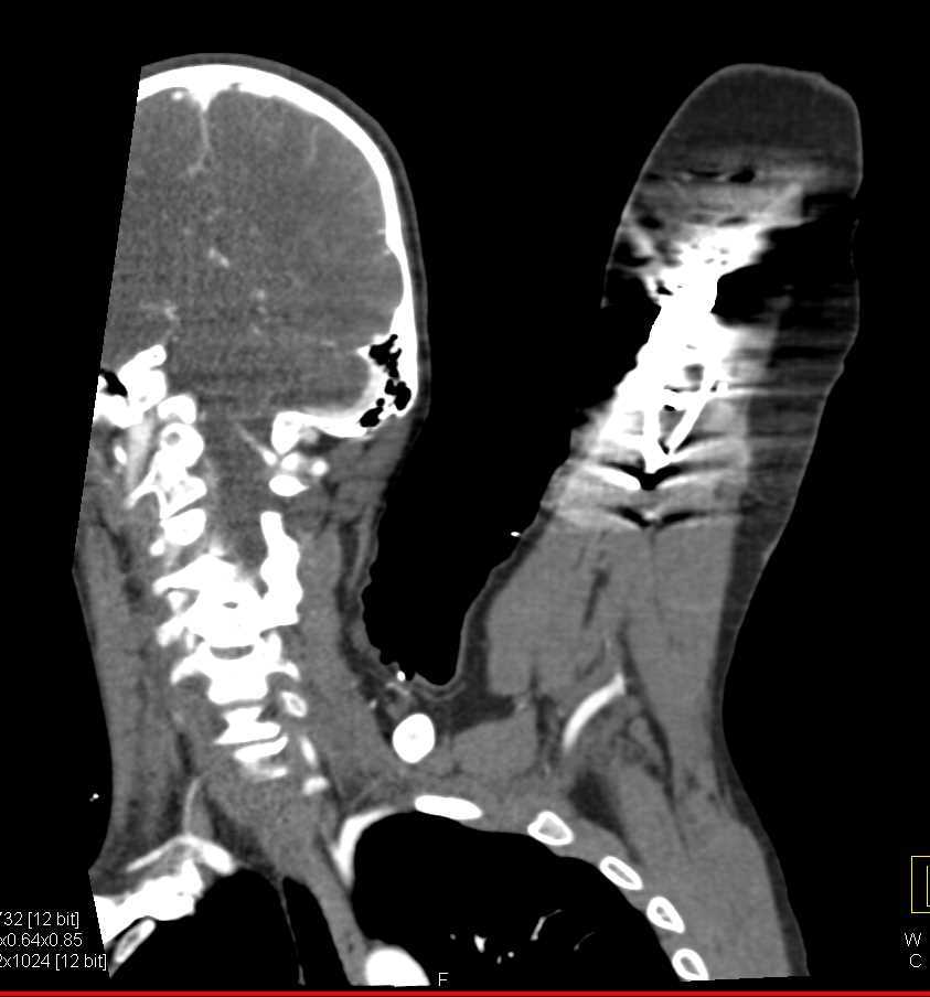 CTA Shows Patent Brachial Artery Despite Hardware in Place - CTisus CT Scan