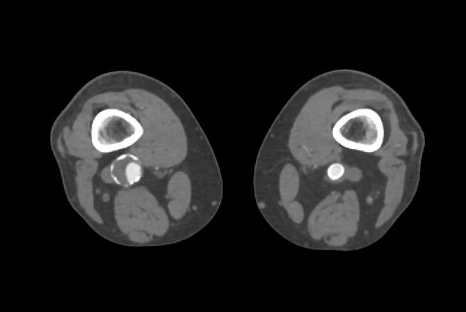 Right Popliteal Artery Aneurysm and Stent in Left Popliteal Artery - CTisus CT Scan
