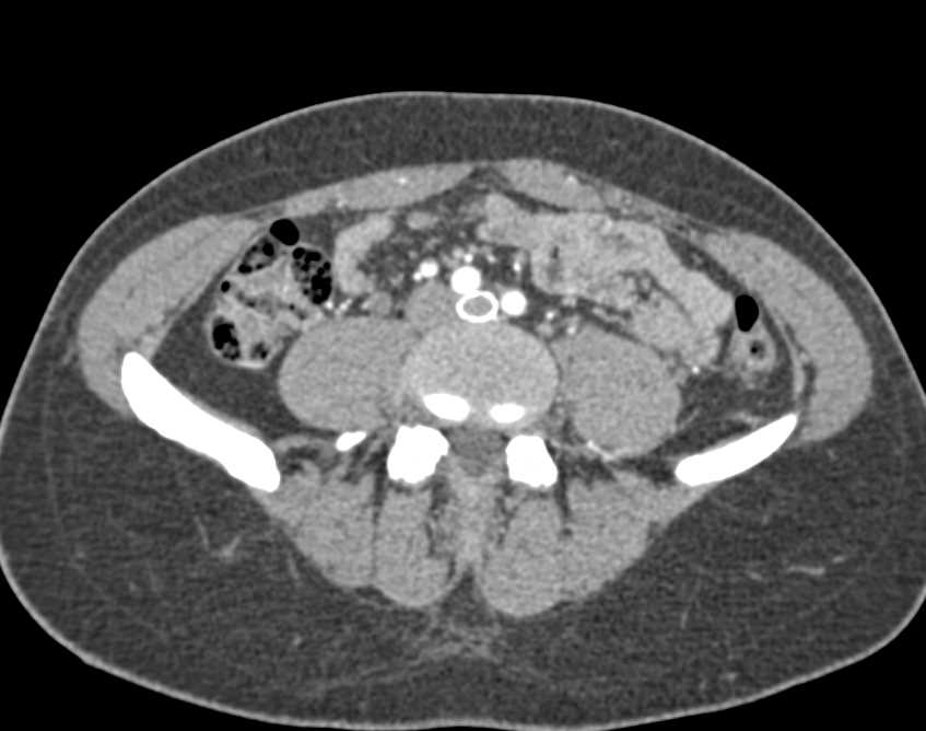 May-Thurner Syndrome (MTS) with Stents in Place - CTisus CT Scan