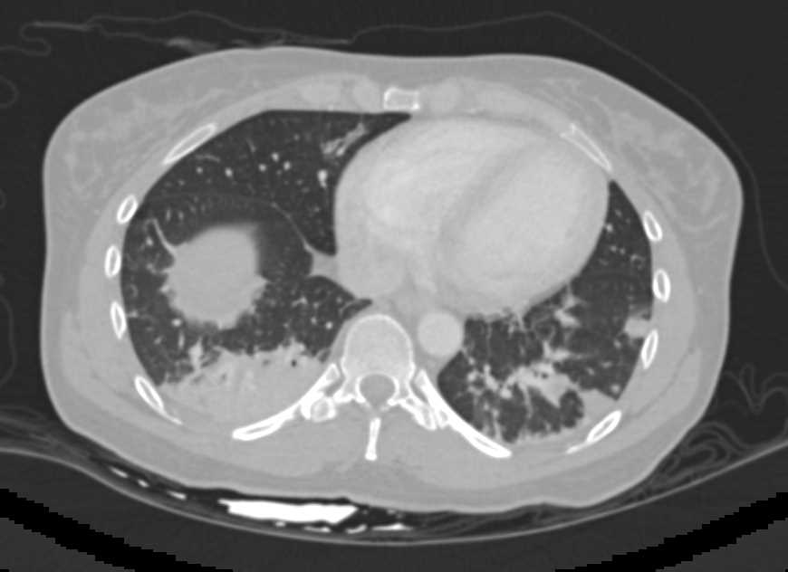 Clot in Inferior Vena Cava (IVC) and Pulmonary Emboli (PEs) - CTisus CT Scan