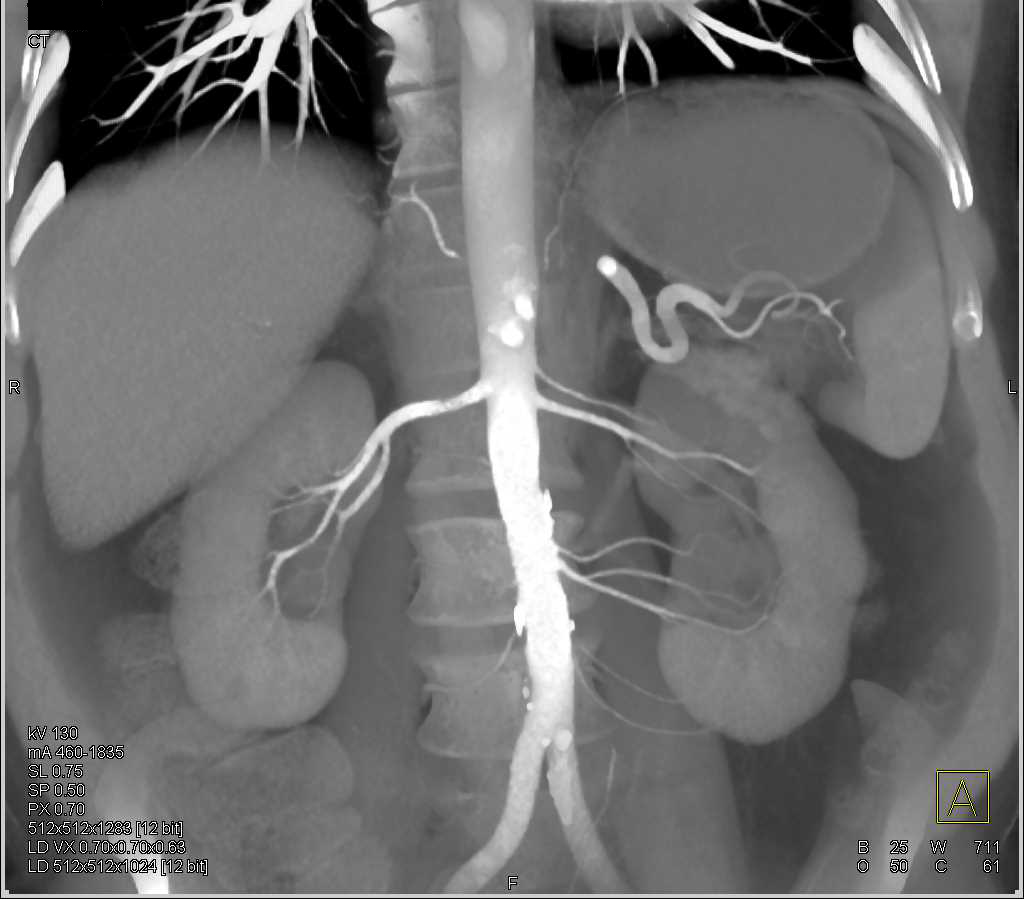 Four Left Renal Arteries - CTisus CT Scan