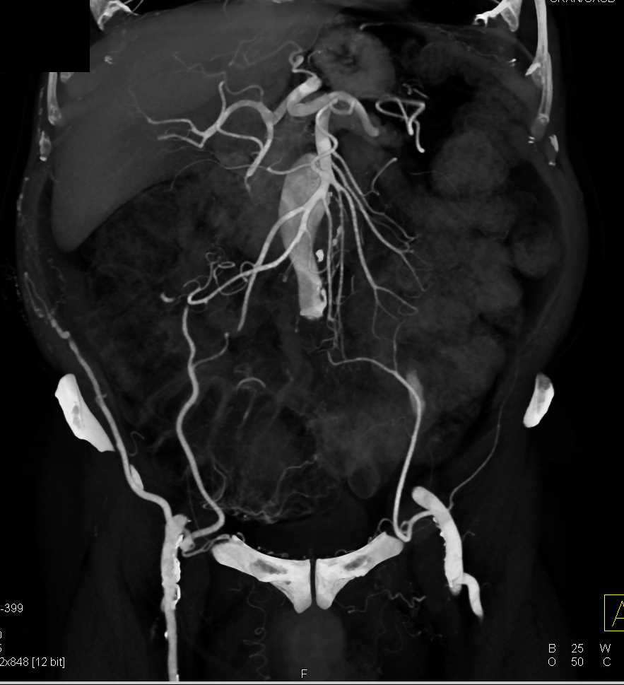 Occluded Right Common Iliac Artery with Collaterals - CTisus CT Scan