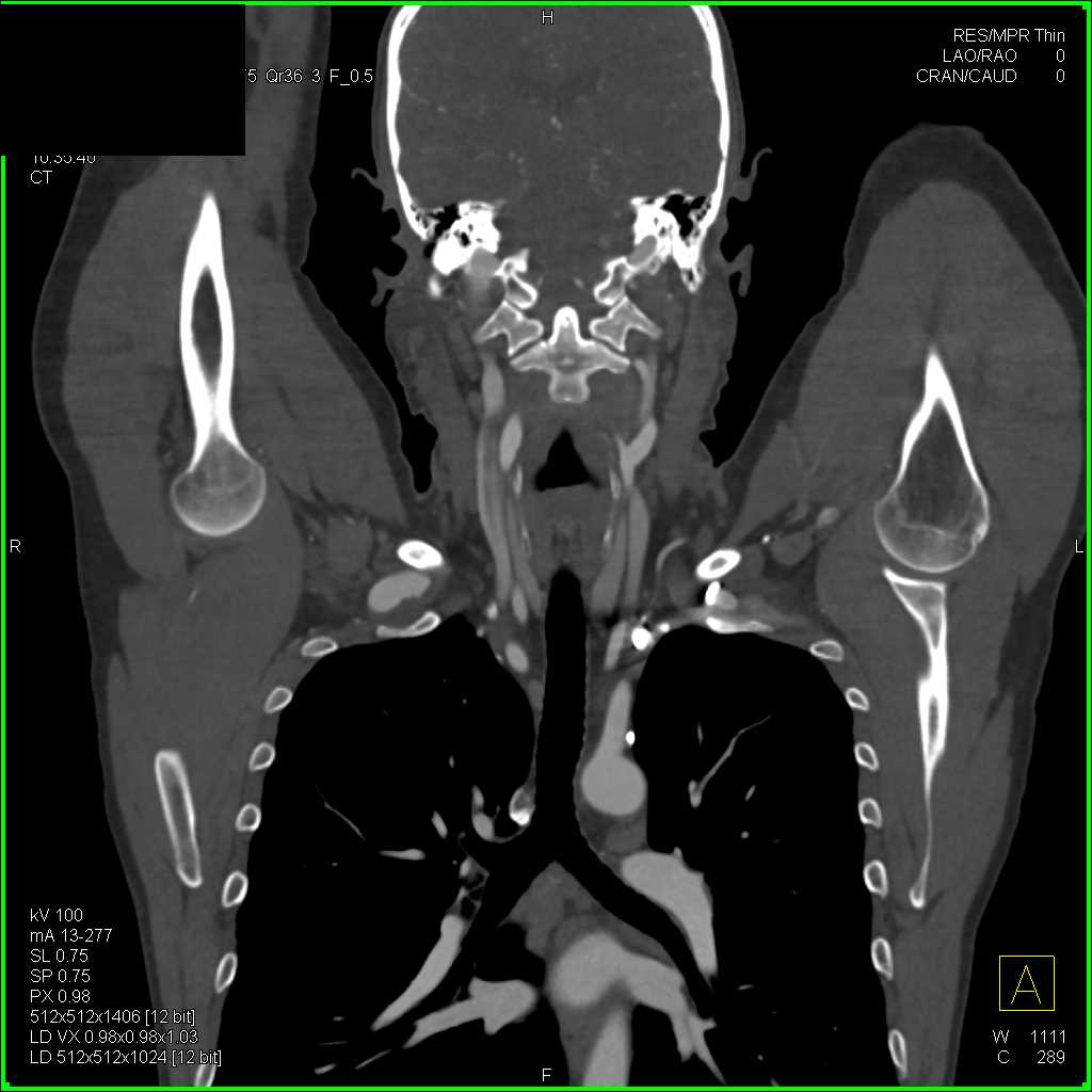 Dilated Right Subclavian Artery with Cervical Rib - CTisus CT Scan
