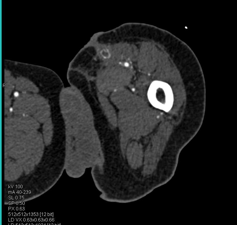 Occlusion of Vascular Stent in Thigh - CTisus CT Scan