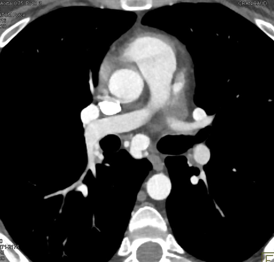 Dilated Bronchial Arteries and Bronchial Artery Aneurysm - CTisus CT Scan