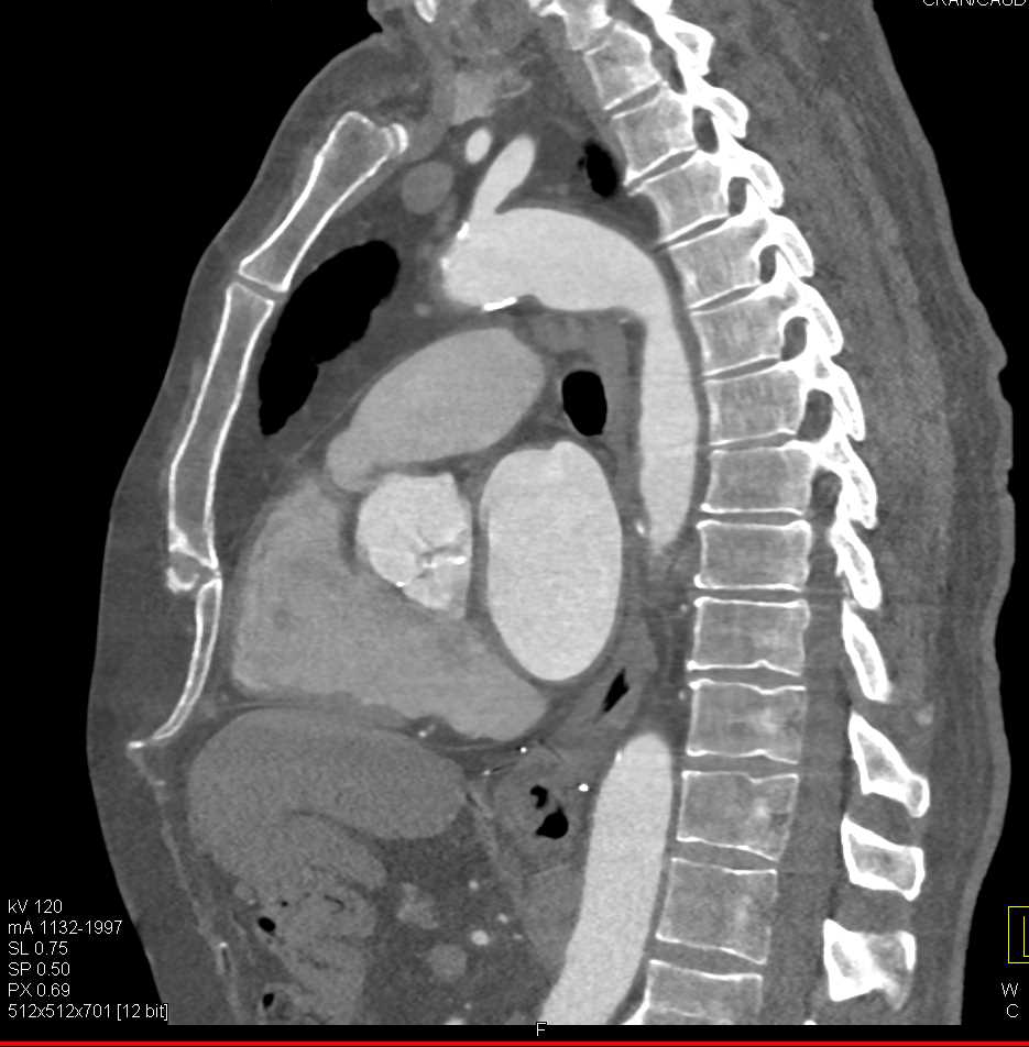 Aortic Valve Calcifications and Pre Transcatheter Aortic Valve Replacement (TAVR) - CTisus CT Scan