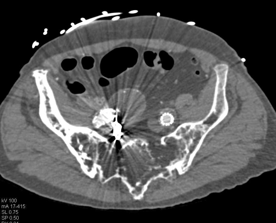 Failed Endovascular Stent with Shape Angulation - CTisus CT Scan