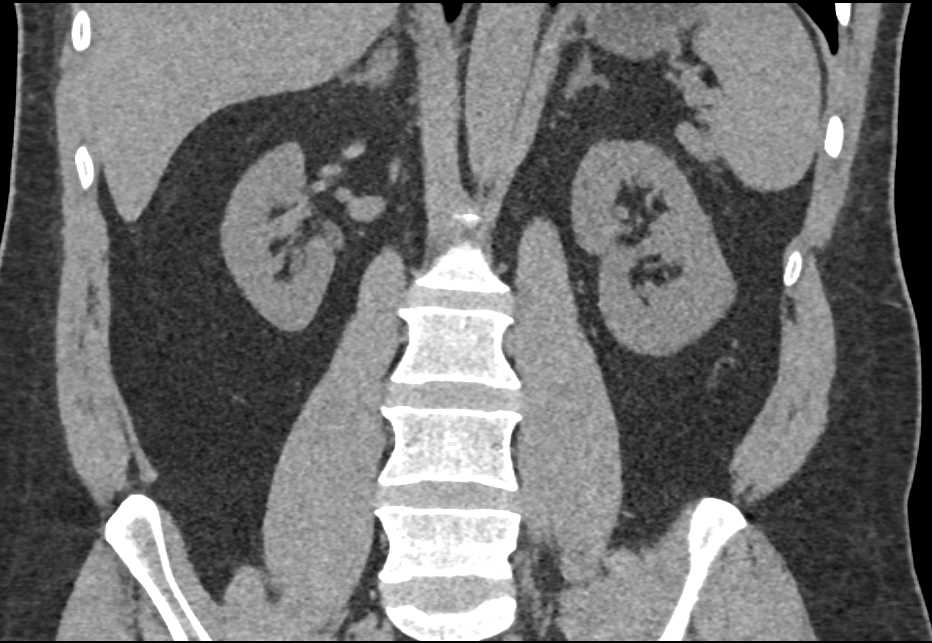FMD (Fibromuscular Dysplasia) of the Left Renal Artery - CTisus CT Scan