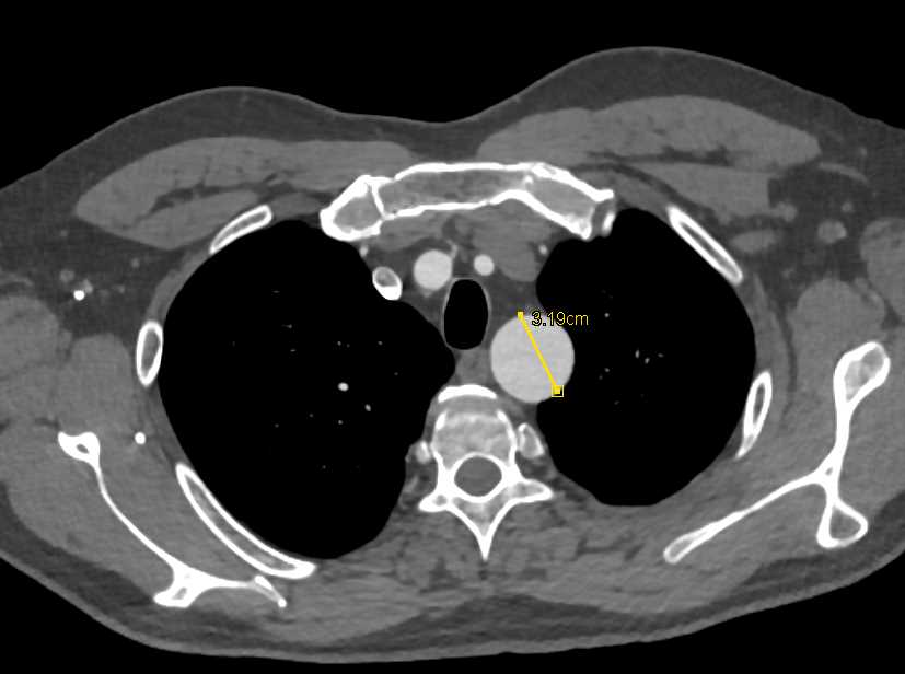 Post Coarctation Repair with Stent and Dilated Left Subclavian Artery - CTisus CT Scan