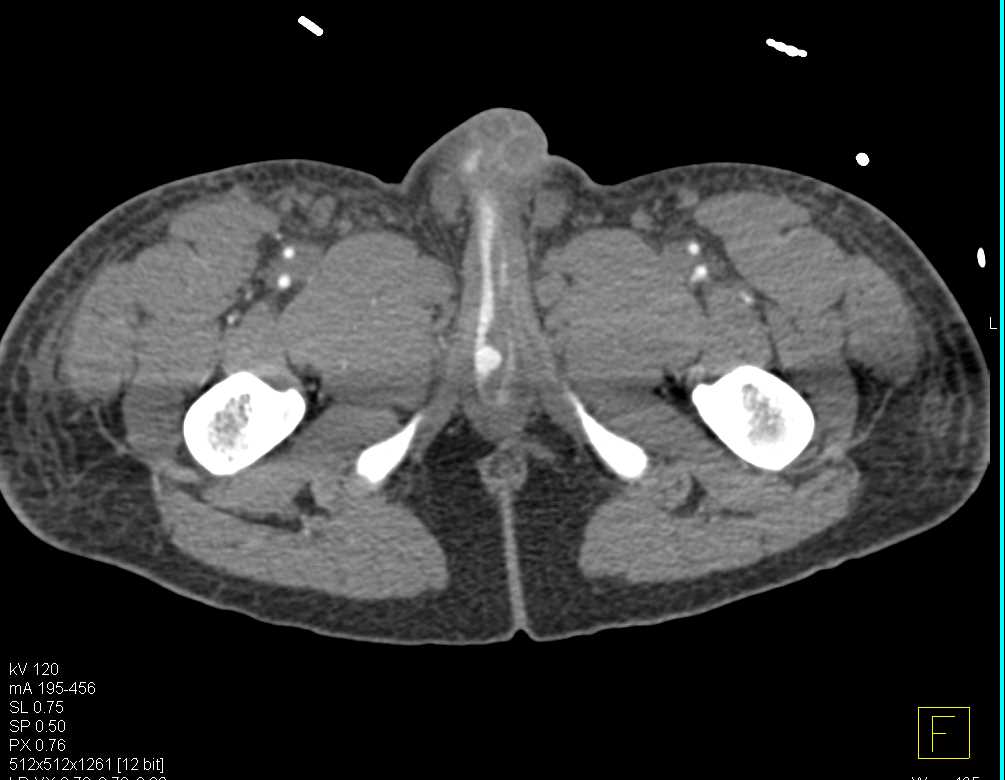 Pseudoaneurysm Near Urethra - CTisus CT Scan