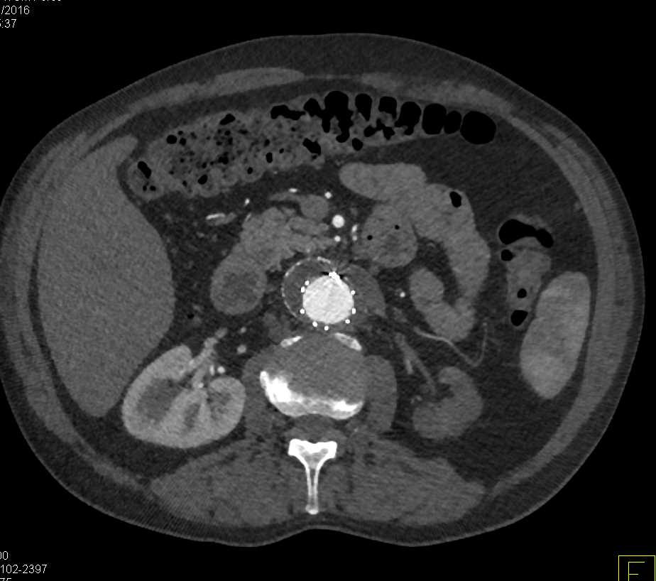 Endovascular Stent Without Endoleak - CTisus CT Scan