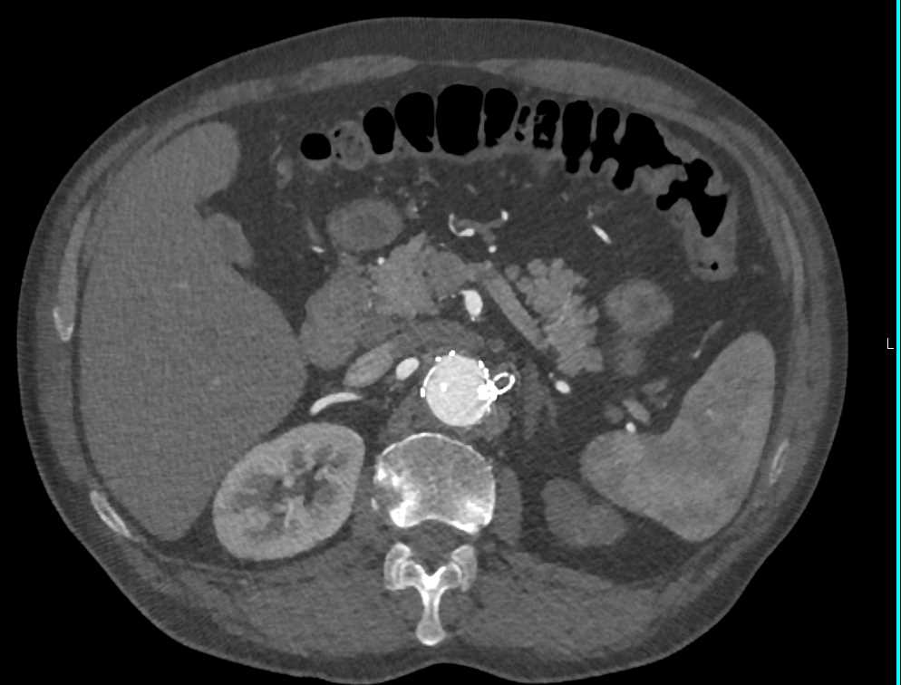 Occluded Stent in Left Renal Artery with Renal Infarcts - CTisus CT Scan