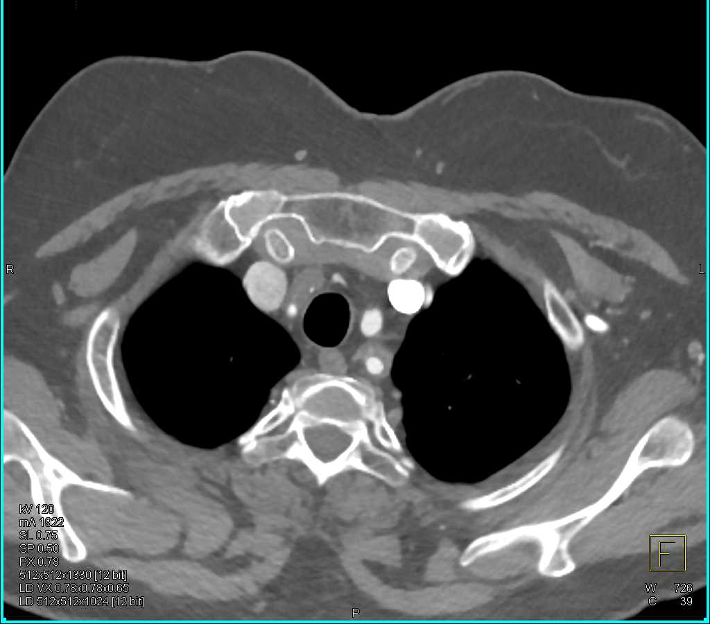 Takayasu's Arteritis with Involvement of the Left Subclavian Artery - CTisus CT Scan