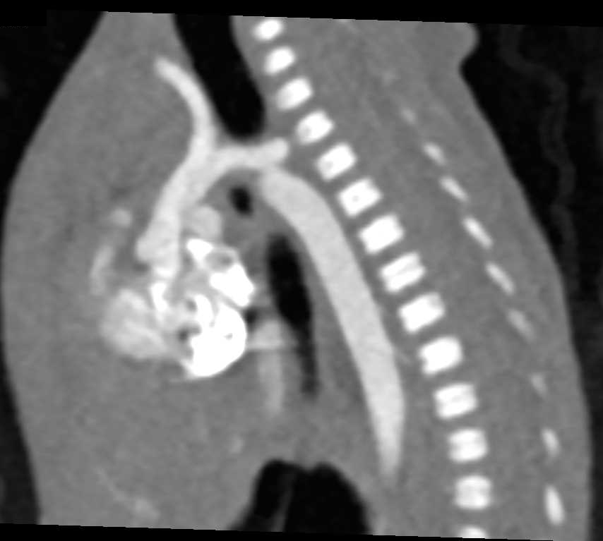 Coarctation of the Aorta - CTisus CT Scan
