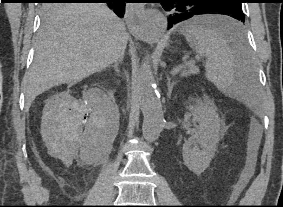 Renal Artery Aneurysm with Active Bleed - CTisus CT Scan