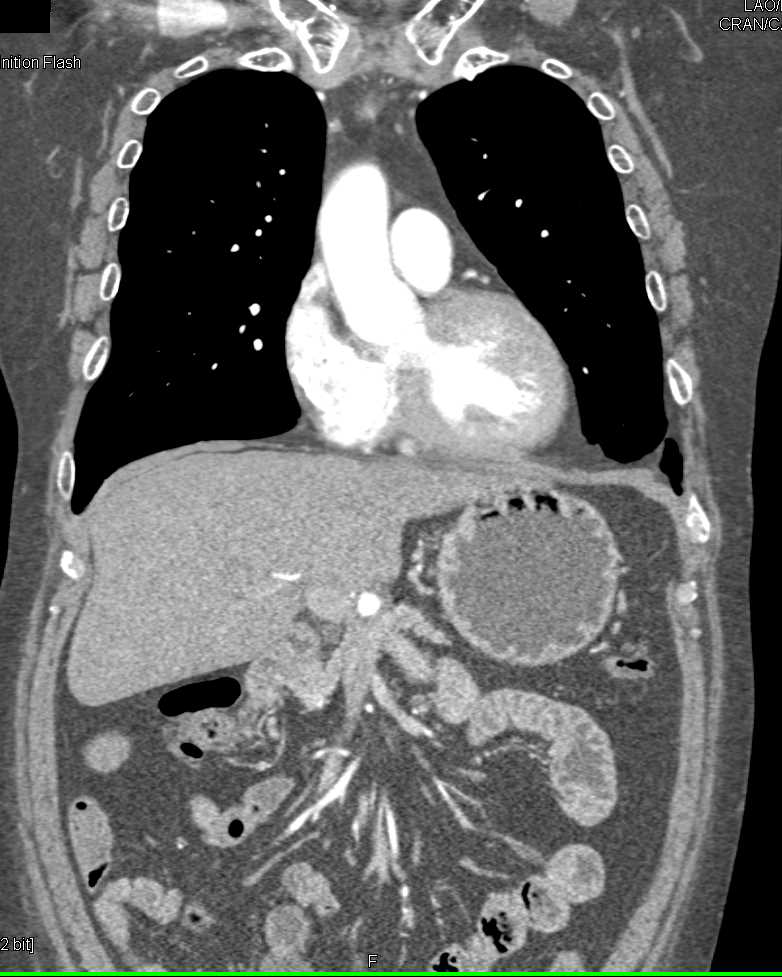 Hepatic Artery Aneurysm - CTisus CT Scan