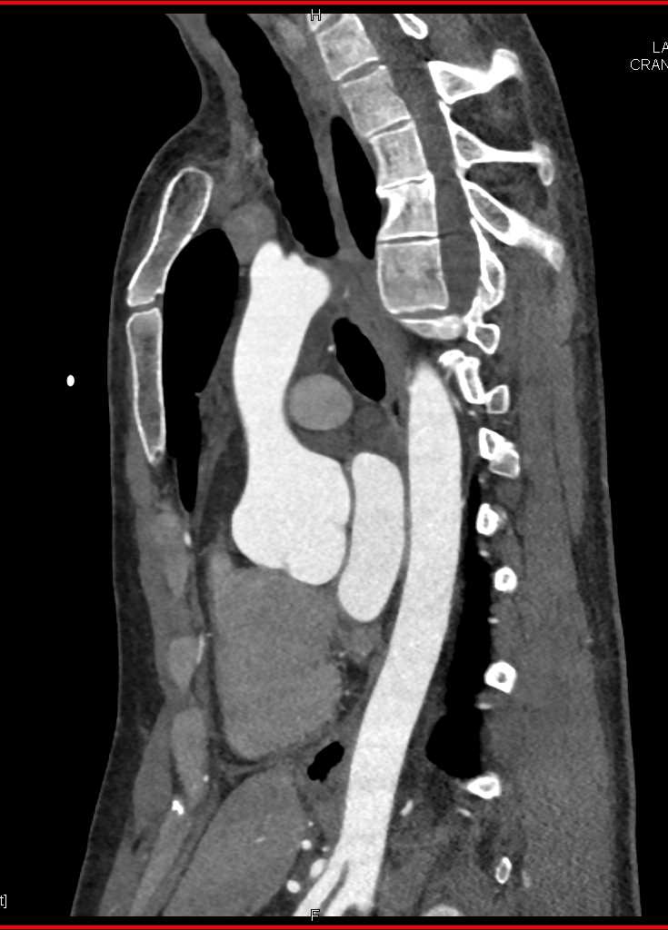 Dilated Aortic Root - CTisus CT Scan