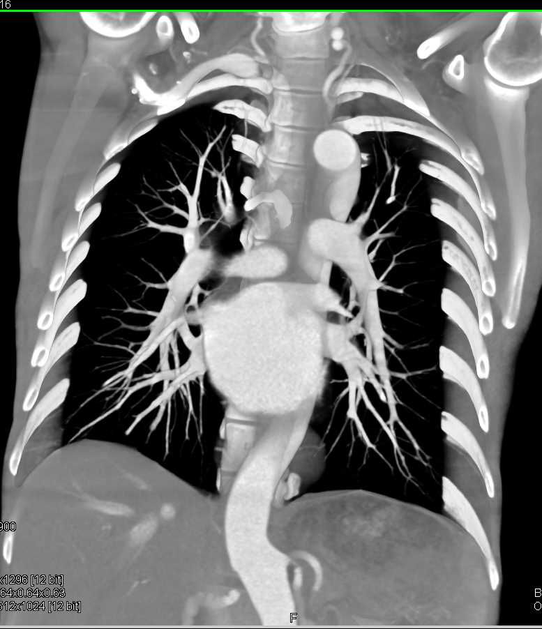 FMD (Fibromuscular Dysplasia) Involves the Renal Arteries - CTisus CT Scan