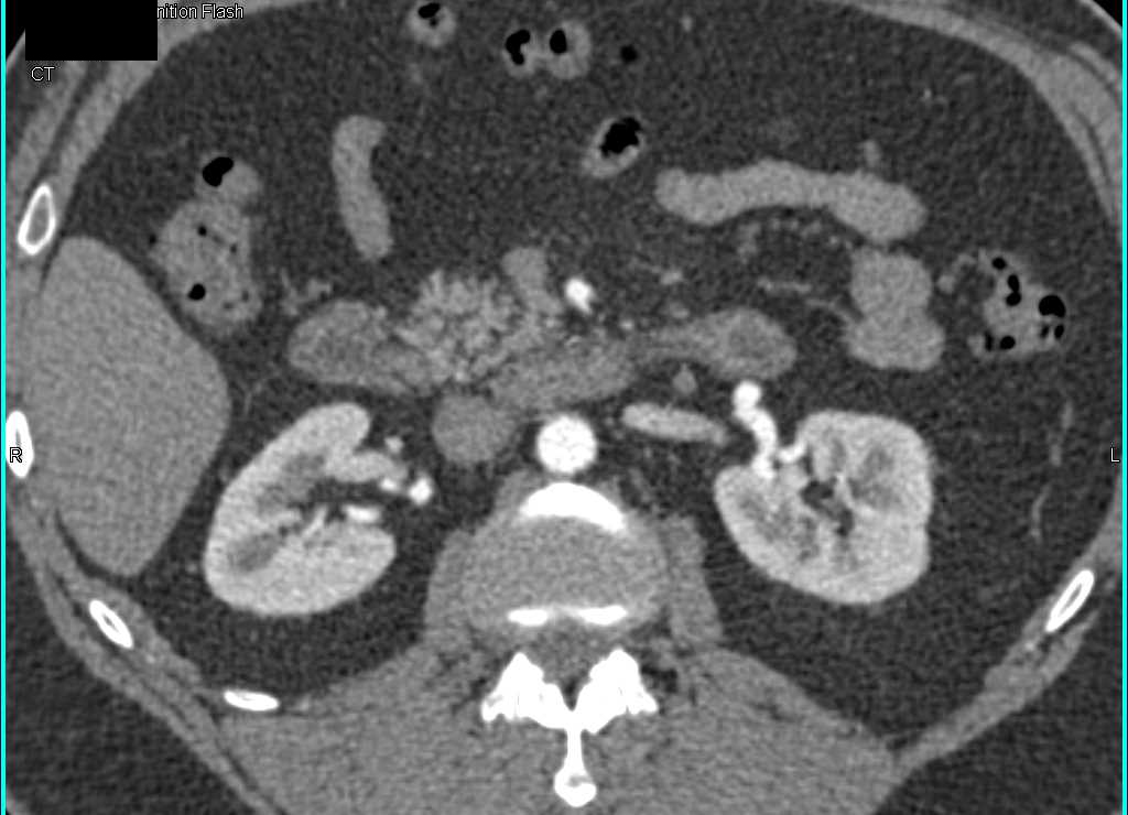 Left Renal Artery Aneurysm and Incidental Left Adrenal Adenoma - CTisus CT Scan