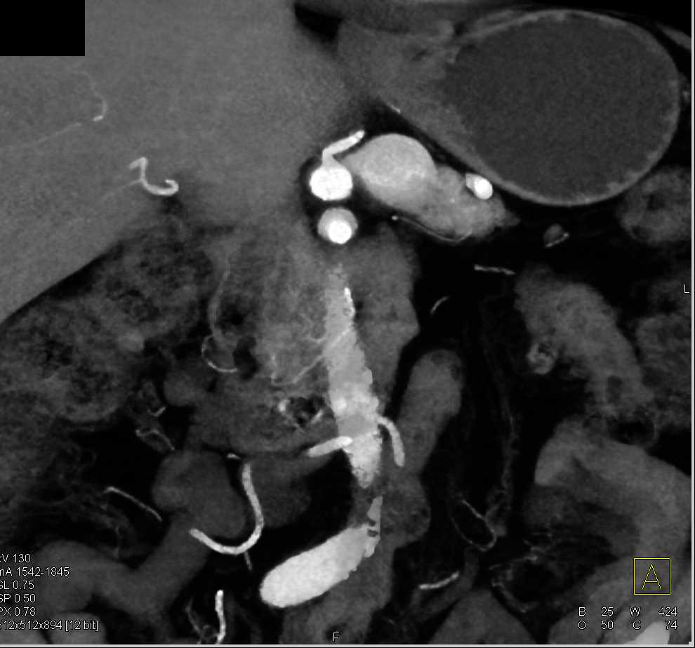 Gastric Artery Aneurysm and Vasculitis - CTisus CT Scan