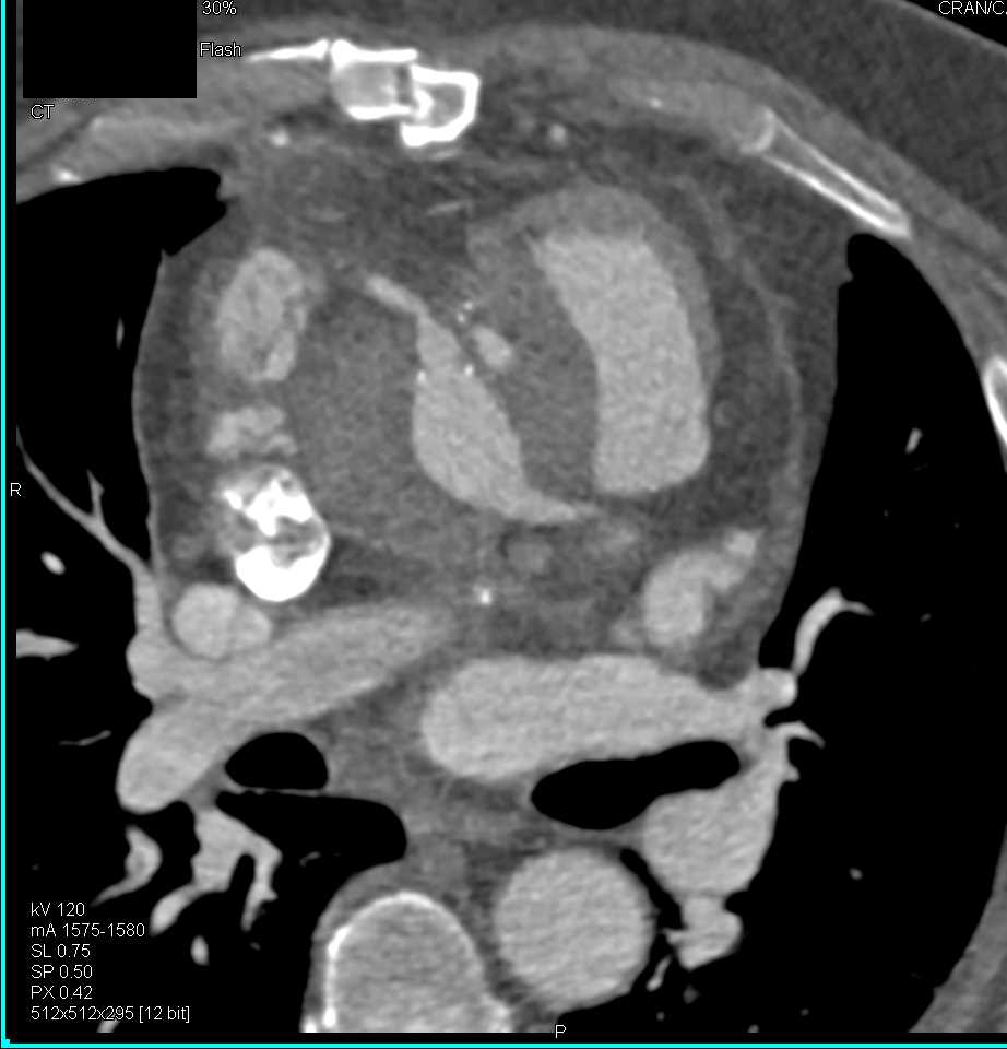 Aortic Repair Post Type A Dissection - CTisus CT Scan