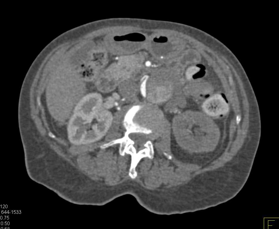 Aortic Dissection Involves the Left Renal Artery with Delayed Perfusion - CTisus CT Scan
