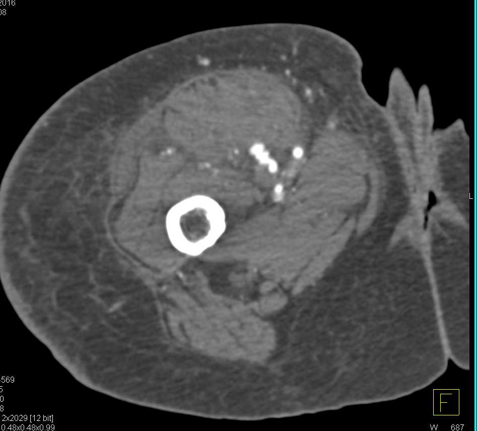Pseudoaneurysm Right Superficial Femoral Artery (SFA) S/P Trauma - CTisus CT Scan