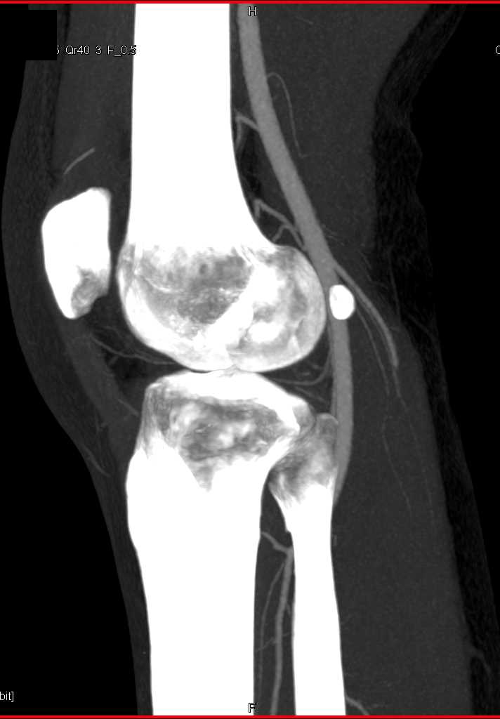 Normal Popliteal Artery Post Trauma - CTisus CT Scan