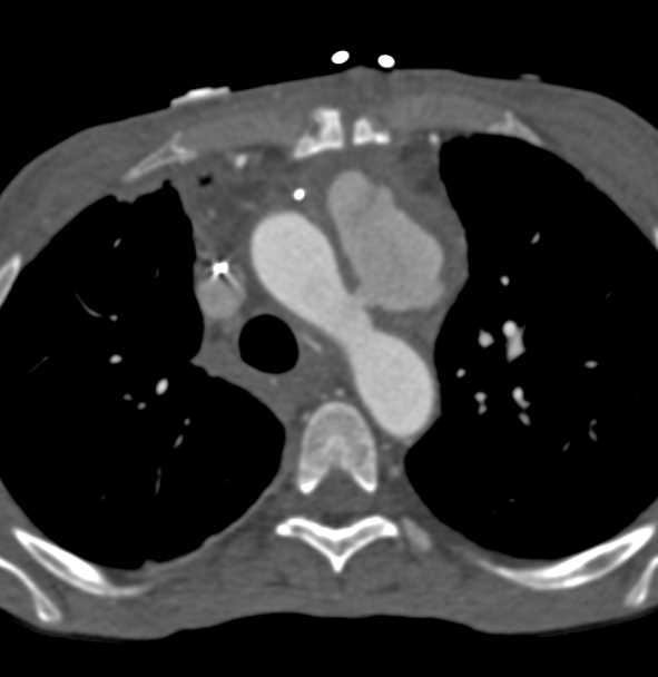 Leaking Aortic Aneurysm - CTisus CT Scan
