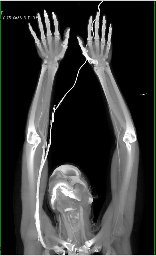 Occluded Left Radial Artery near the Origin - CTisus CT Scan