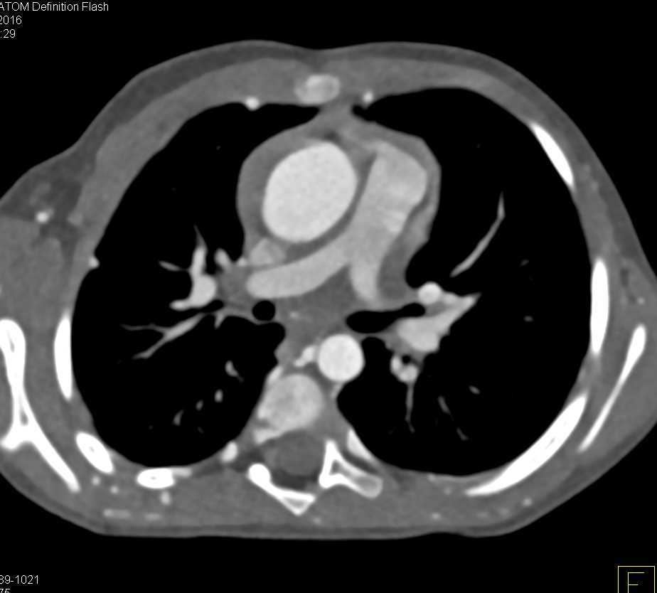 Coarctation of the Aorta with Extensive Collaterals - CTisus CT Scan
