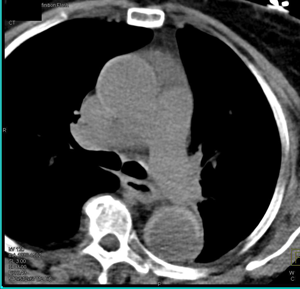 Intramural Hematoma - CTisus CT Scan