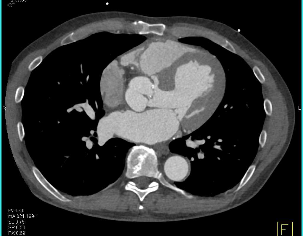 Coarctation of the Aorta with Repair - CTisus CT Scan