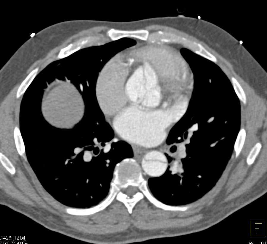 Type A Aortic Dissection - CTisus CT Scan