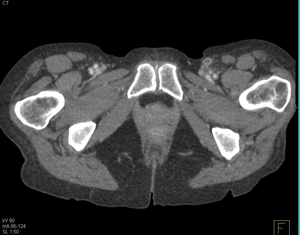 Occlusion of Left Vascular Grafts - CTisus CT Scan