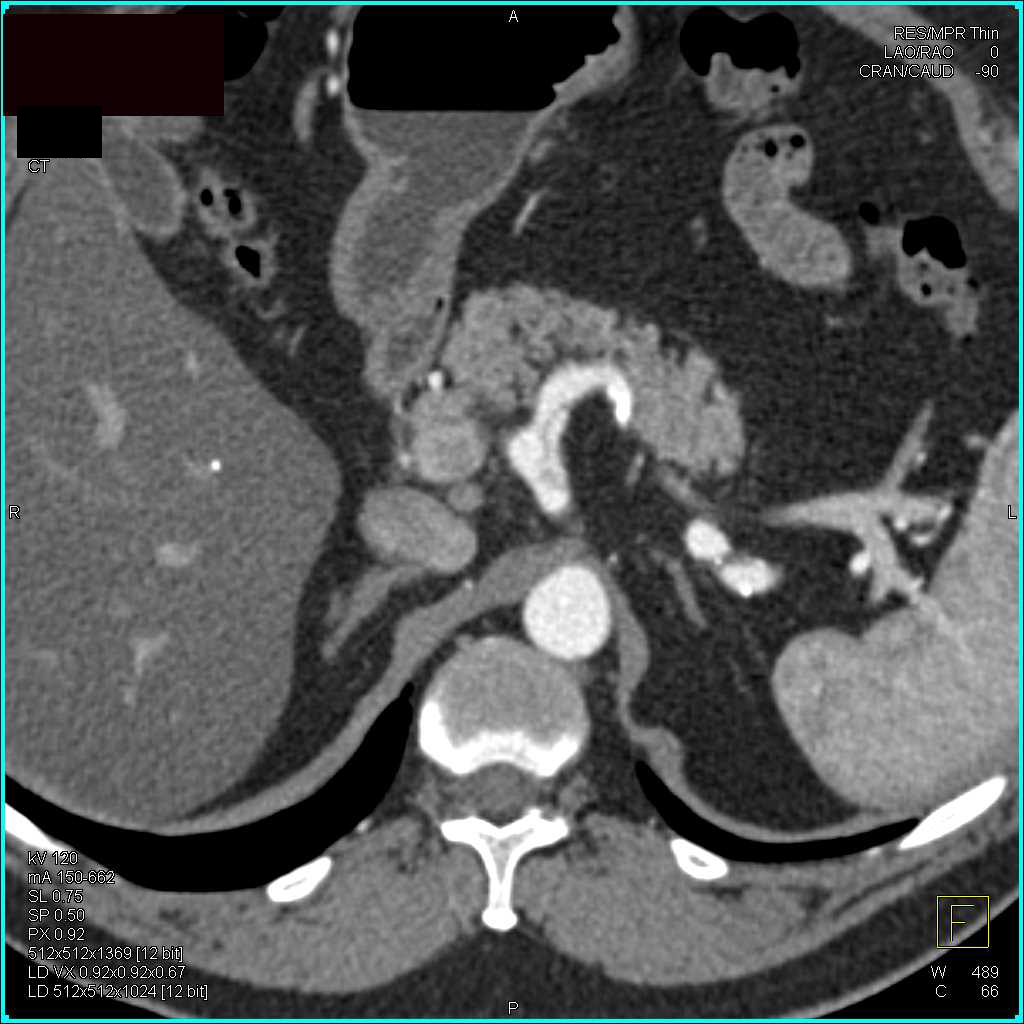 Celiac Artery Dissection - CTisus CT Scan