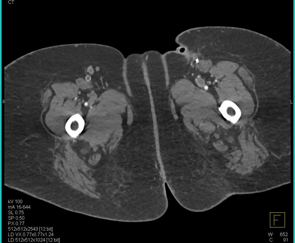 Occlusion of Vascular Stents - CTisus CT Scan