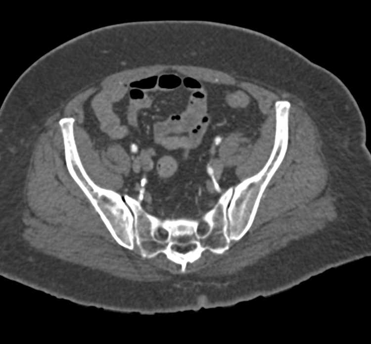 Peripheral Vascular Disease with Occluded Stents - CTisus CT Scan