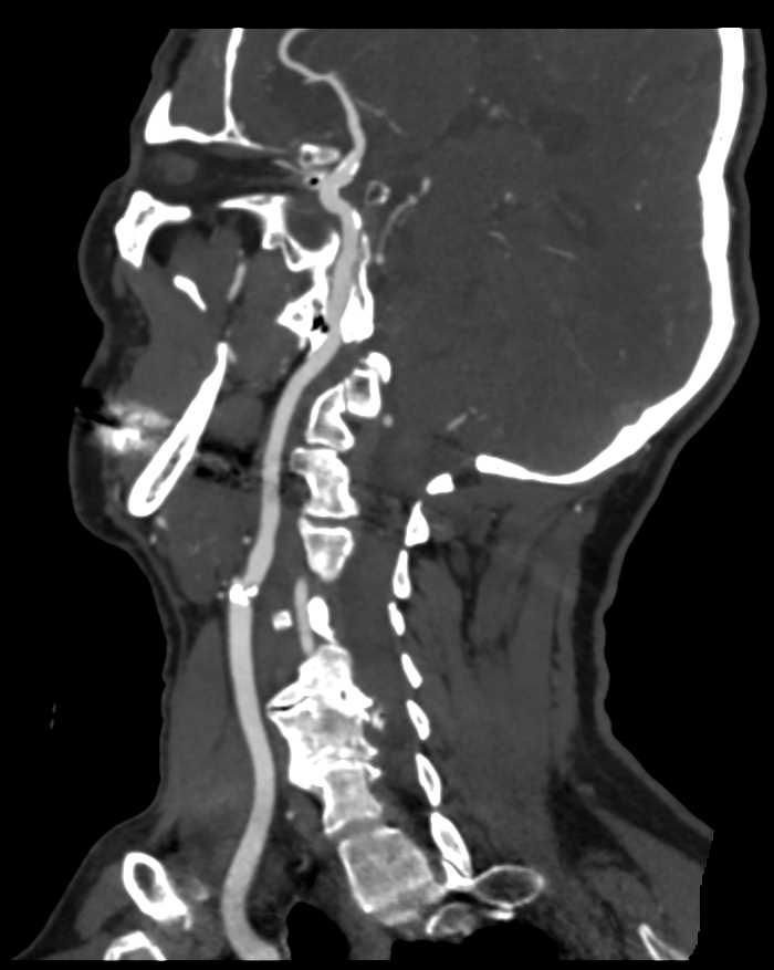 Plaque on the Carotid Artery - CTisus CT Scan