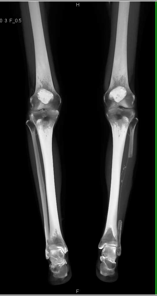 Fibular Flap Study After Harvest - CTisus CT Scan