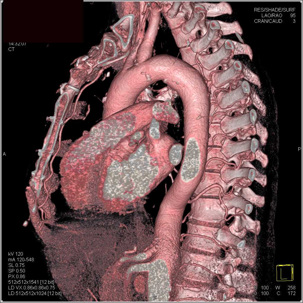 Intramural Hematoma with Ulceration - CTisus CT Scan
