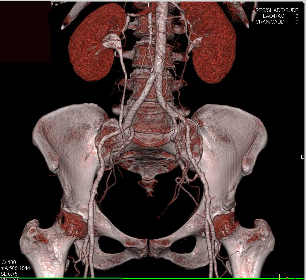 CTA and CT Urogram Together - CTisus CT Scan