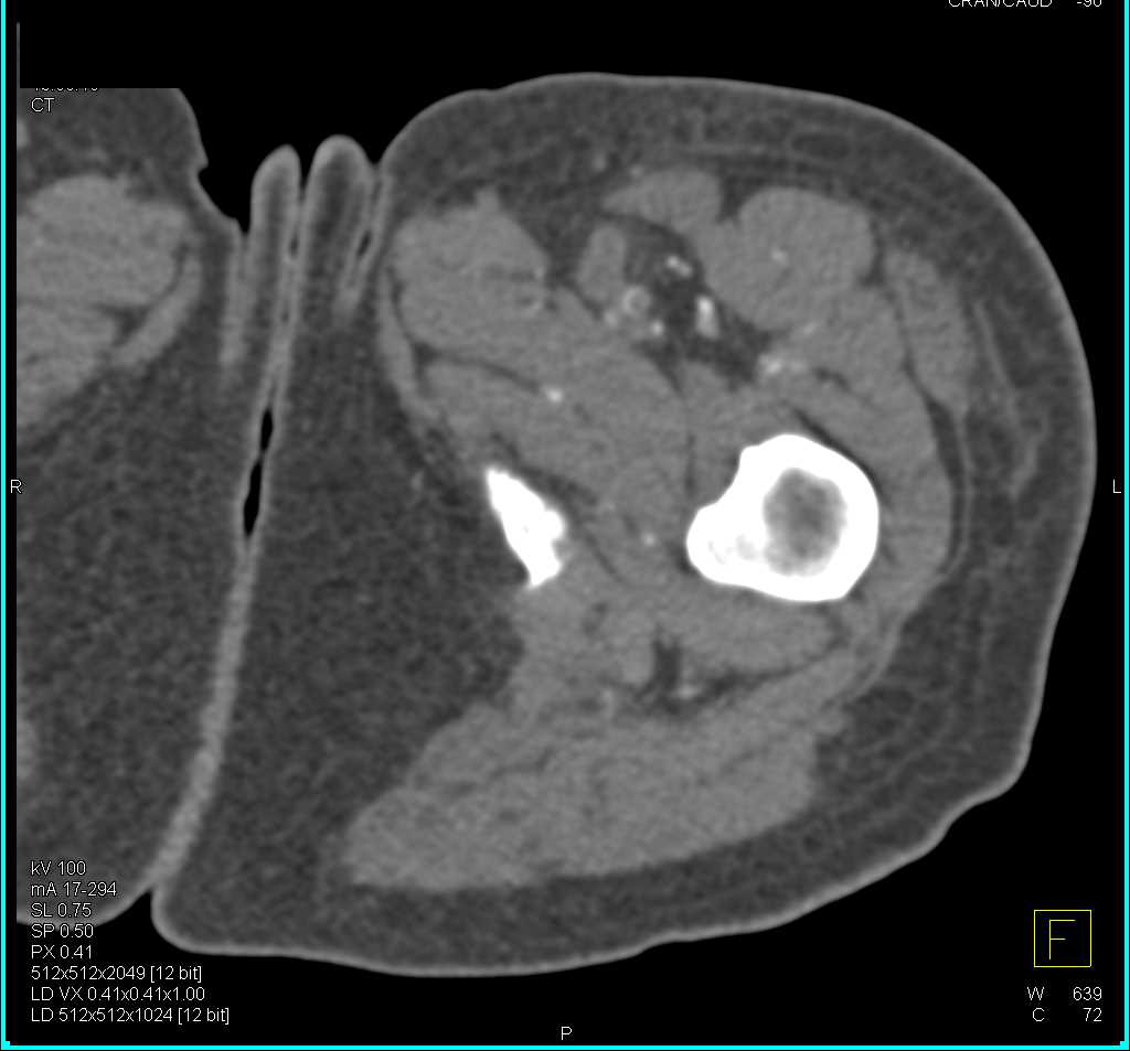 Superficial Femoral Artery (SFA) is Occluded - CTisus CT Scan
